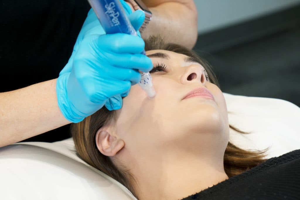 SkinPen microneedling treatment — 2
