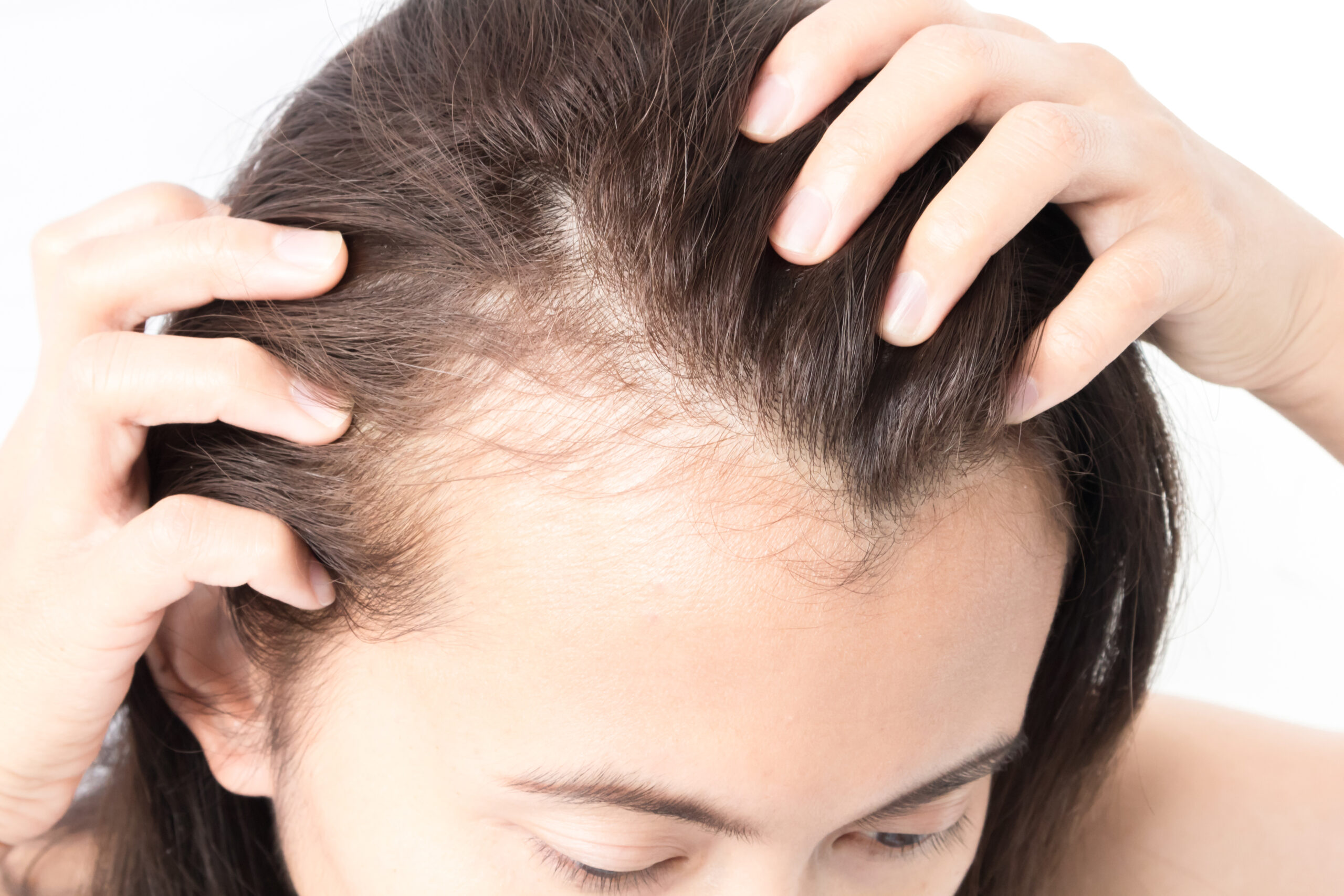 PRP Hair Restoration - Encompass Aesthetics and Wellness